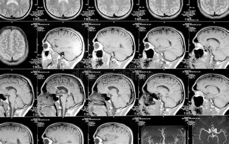 Mri Aftasten Of Magnetische Resonantiebeeld Van Hoofd En