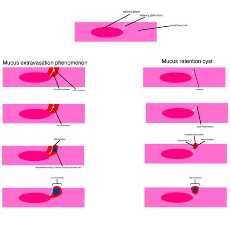 oral mucocele wikipedia