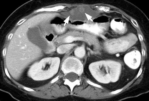 Gastrointestinal Stromal Tumor Role Of Ct In Diagnosis And In Response