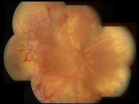 Acute Retinal Necrosis