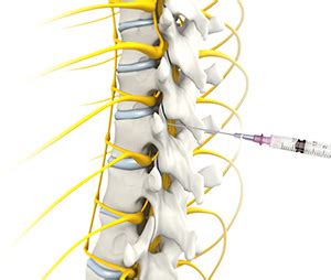 Epidural Steroid Injections Houston Herniated Disc Spinal Stenosis