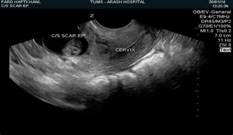 Successful Local And Systemic Medical Treatment Of Cesarean Scar