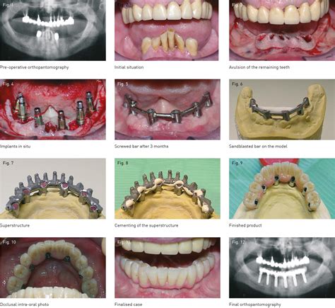 Immediate Loading Of Mandibular Implants Sweden Martina