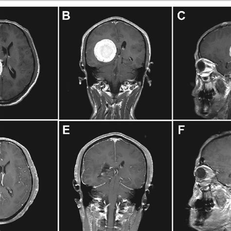 Ventricular Meningioma Resection Via The Posterior Temporal Keyhole