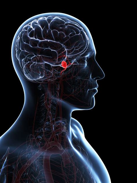 Recognizing And Reacting To Cerebral Aneurysms