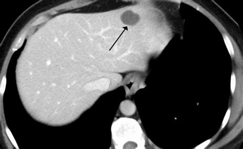 Hemangioma Hemangioma Of Skin Spine Liver Causes Treatment Otosection