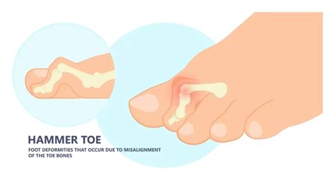 How To Fix Hammertoe Rocky Mountain Foot Ankle