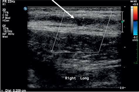 Figure 1 From Superficial Abdominal Thrombophlebitis Mondor S Disease