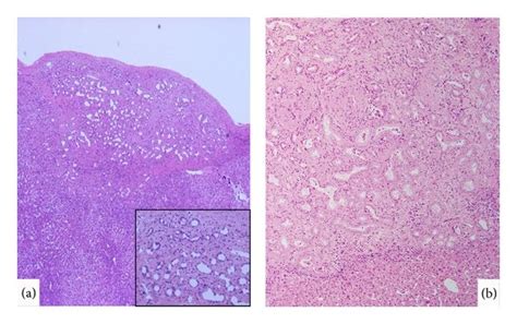 Bile Duct Adenoma A Ordinary Bile Duct Adenoma Is Seen Under Hepatic