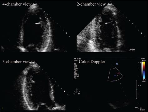 Stress-echocardiography or coronary computed tomography in s ...