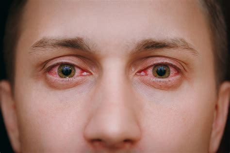 Why Are My Eyes Bloodshot? - Eye Clinic of Florida