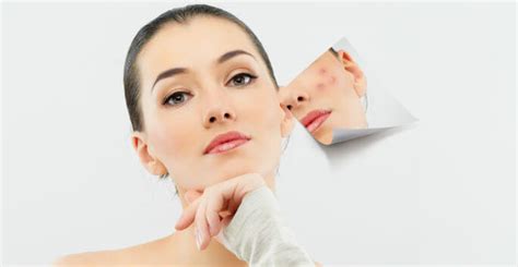 How Hormonal Changes Affect Acne Development - Orlando FL - Dr ...