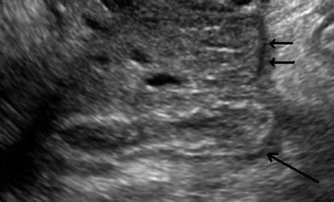 Transvaginal Sonogram In A Year Old Patient Shows A Thick Walled