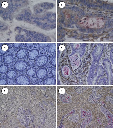 Co Staining Of Cd133 And α Smooth Muscle Actin α Sma Showing The