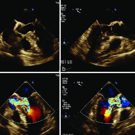 Systolic Anterior Motion Of The Mitral Chordae Tendineae Arrow In