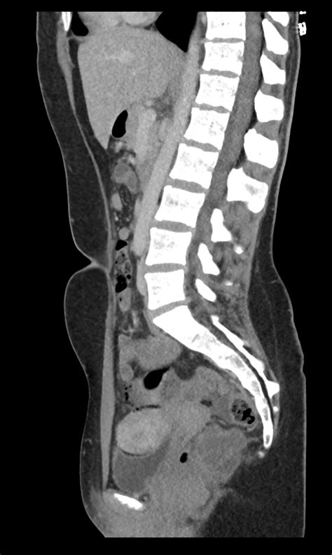 Tailgut Duplication Cyst Image Radiopaedia Org