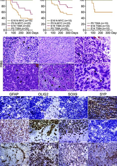 N Myc T A Induces Brain Tumors From Both Cerebellum And Forebrain