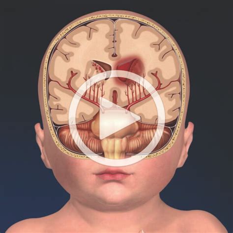 Germinal Matrix Brain Anatomy