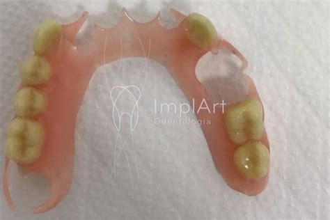 Prótese de Silicone Flexível 1 Sorriso Completo e Estético