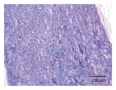 Masson Trichrome Staining Of Lsg A And B Tissue Fibrosis Seen At