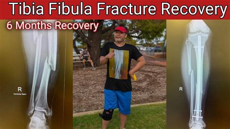 Tibia Fibula Fracture Recovery 6 Months Main Full Recovery Hugye Or