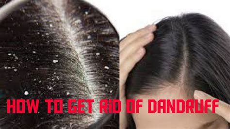 How To Get Rid Of Dandruff Naturally చుండ్రు సమస్య తగ్గించే ఇంటి