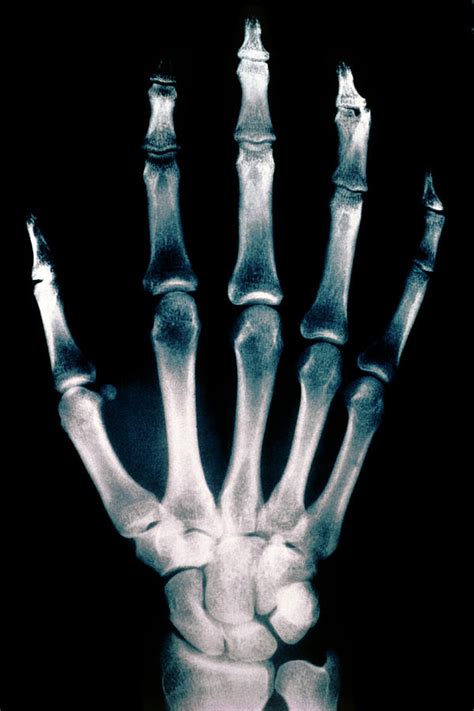 Colorvir X Ray Photo Of Normal Right Hand By Stammersthompsonscience