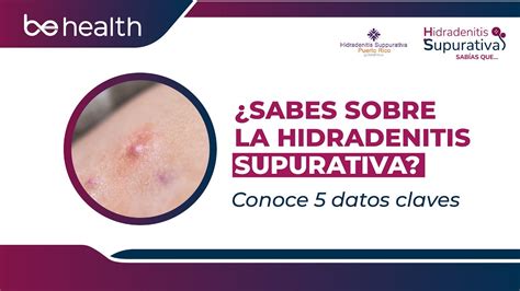 5 Datos Claves Para Comprender La Hidradenitis Supurativa Youtube