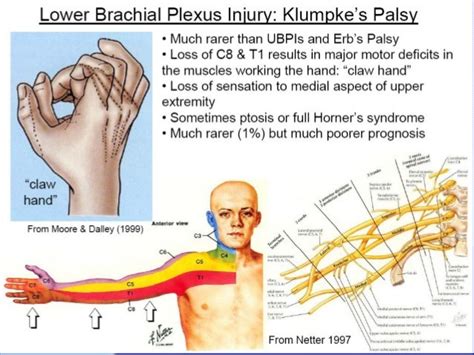 Brachial plexus injuries by krr