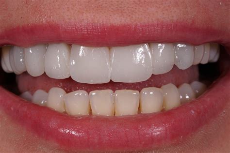 Composite Veneers Fast Cost Effective Smile Upgrade Dental Aesthetics