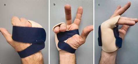 Metacarpal Fractures Alex G Lambi Robert J Rowland Nicholas W