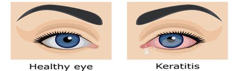 Understanding Acanthamoeba Keratitis Eye Infection Insights Eyeonce Eye Clinic