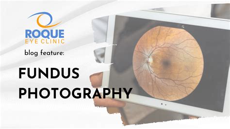 Fundus Photography Roque Eye Clinic Ph