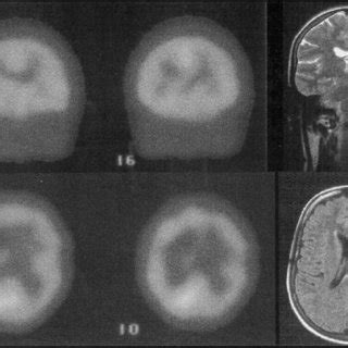 Left Brain Tc ECD 99m SPECT Reveals A Heterogeneous Distribution Of