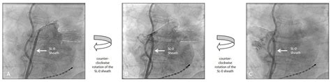 A Simplified Approach To Pulmonary Vein Visualization During Cryoballoon Ablation Of Atrial