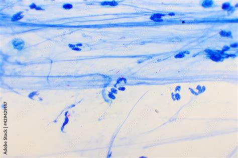 Mycobacterium Tuberculosis Positive Small Red Rod In Sputum Smear Acid Fast Stain Analyze By