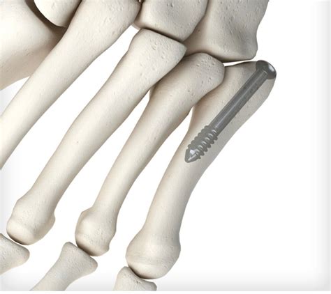 Percutaneous Screw Fixation Jones Fracture Foot And Ankle