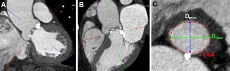 Role Of Computed Tomography Imaging For Transcatheter Valvular Repair