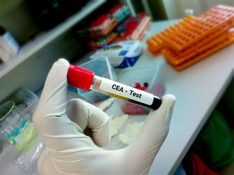 Blood Sample for CEA Test, Tumor Marker for Colon Cancer Stock Image ...