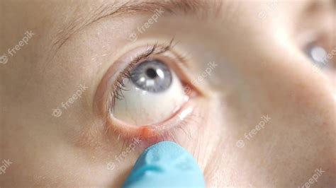 Blepharitis Der Augen Und Wimpern In Nahaufnahme Zuordnung Der