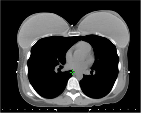 Post Mastectomy Radiotherapy Planning In Patient With Bilateral