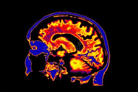 Cérebro CT Que Mostra O Sangramento Intracranial Foto de Stock Imagem