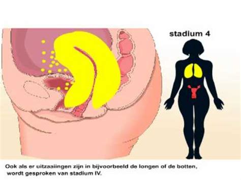 Baarmoederkanker Symptomen En Behandeling Van Baarmoederkanker YouTube