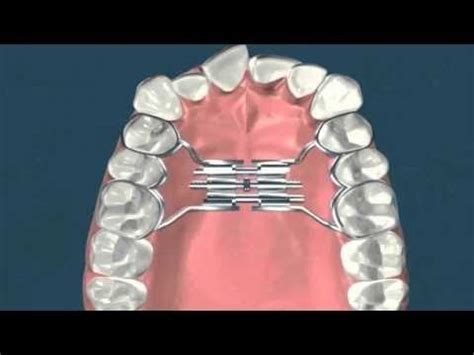 Expansor Maxilar Hyrax Experiencia De Usuario Youtube