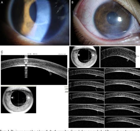 Figure 2 From A Case Of Descemet S Membrane Detachment During Lidocaine Injection For Hordeolum