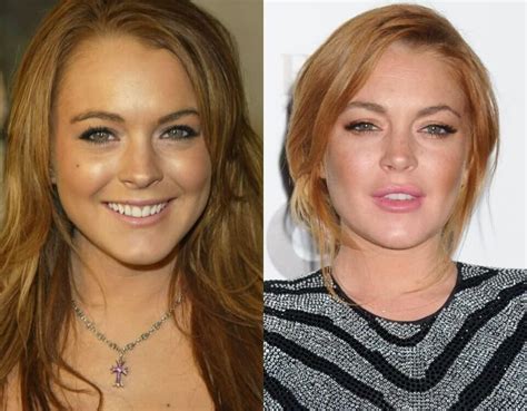 Lindsay Lohan Plastic Surgery Before And After Expert Opinion