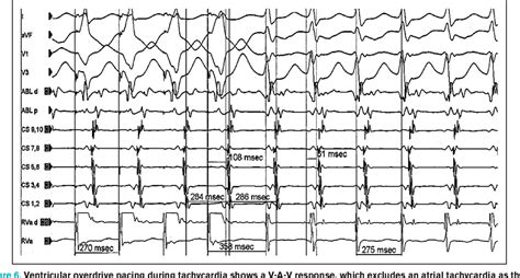 Figure 5 From Ablation Of Supraventricular Tachycardias From Concealed