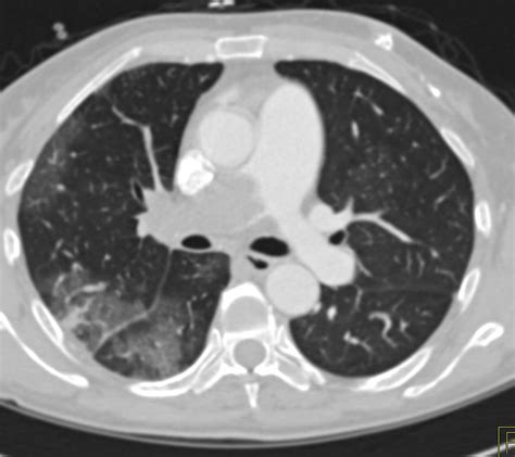 Large Pulmonary Embolism With Lung Infarct And Splenic Infarct Chest