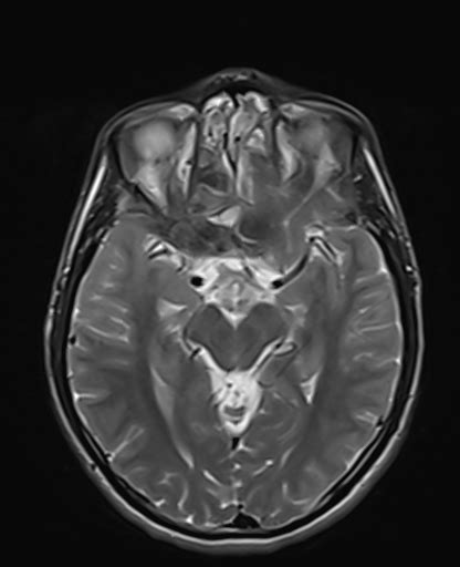 Allergic Fungal Sinusitis Image