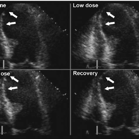 D A Example Of A Normal Dobutamine Stress Echocardiogram The